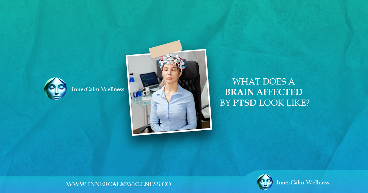 what does a brain affected by PTSD look like